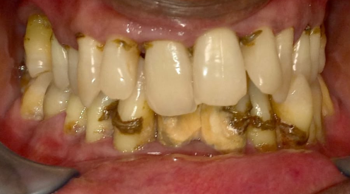 Case 1 After